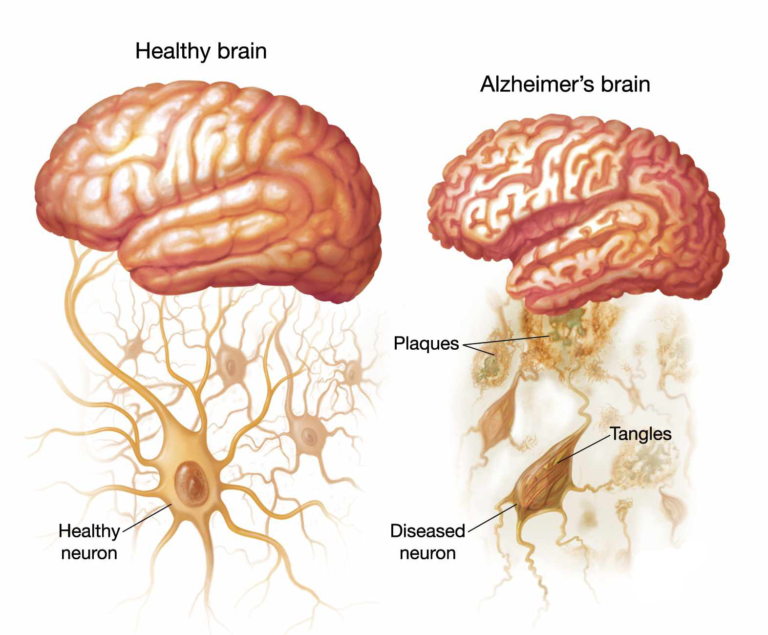 Prevention And Cure Of Alzheimer’s Disease, Post-Stroke Recovery And ...